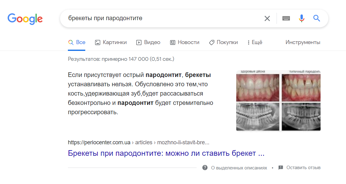 Скрін видачі ПС Google за запитом «брекети при пародонтиті» - фото просування медичного сайту